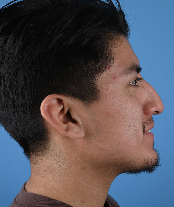 Male Rhinoplasty