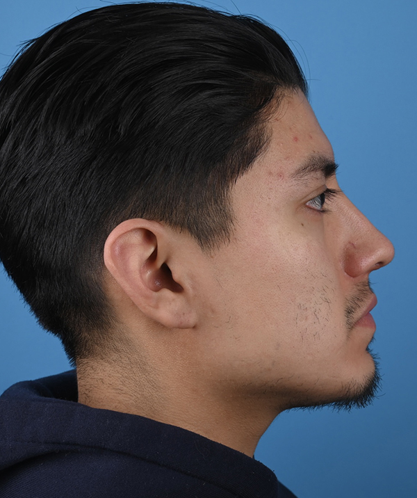 Male Rhinoplasty