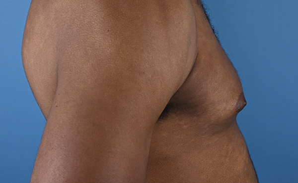 Gynecomastia
