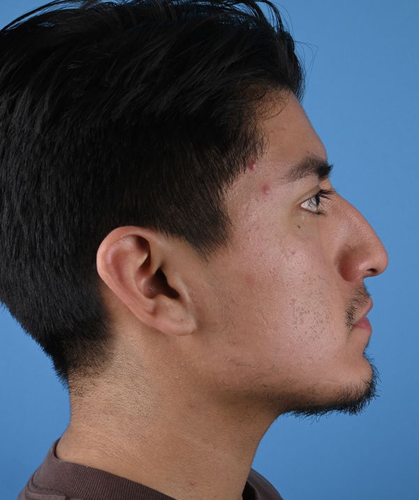 Male Rhinoplasty