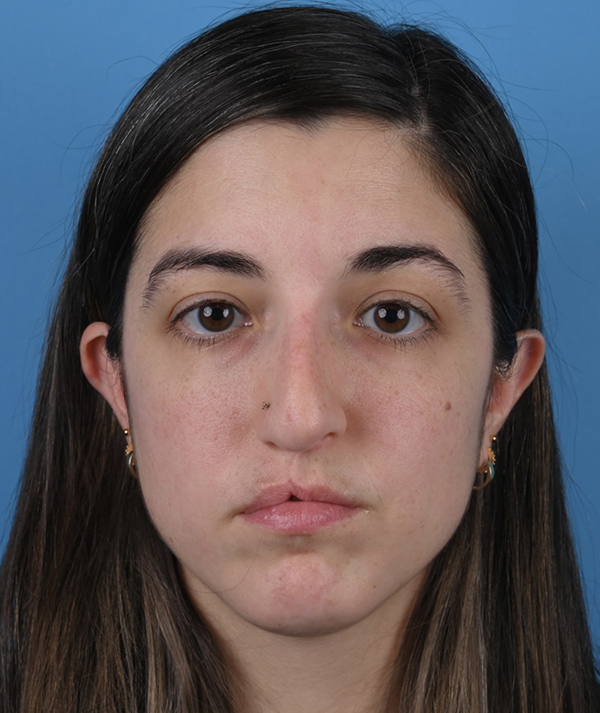 Revision Rhinoplasty