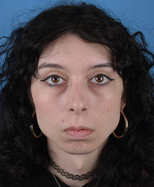 Facial Feminization