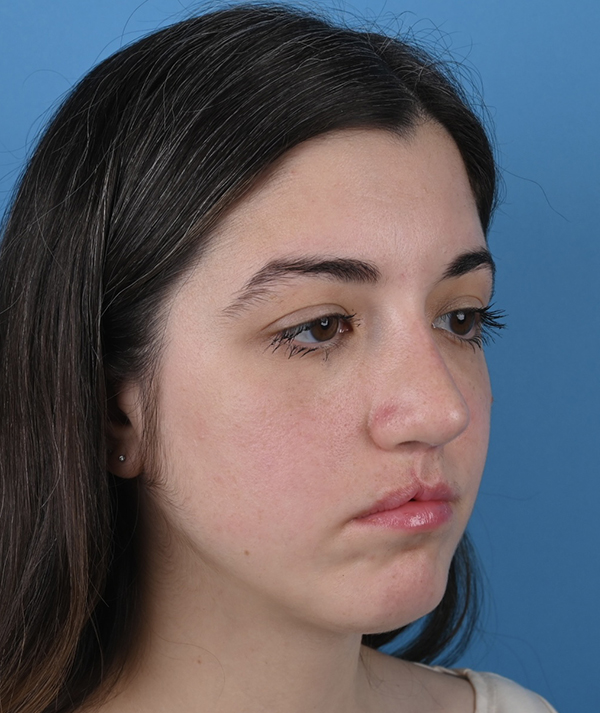 Revision Rhinoplasty