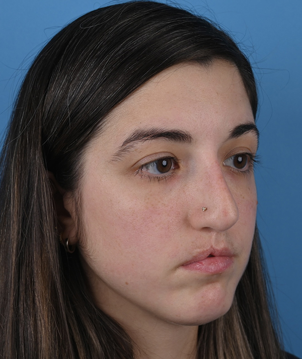 Revision Rhinoplasty