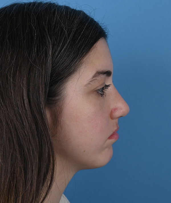 Revision Rhinoplasty