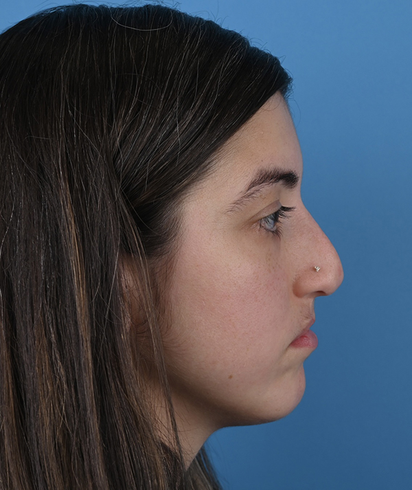Revision Rhinoplasty