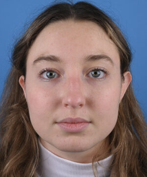 Blepharoplasty