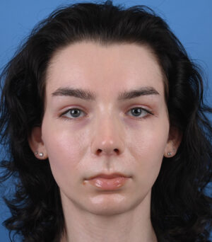 front-view-after-rhinoplasty-47273