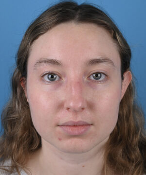 Blepharoplasty