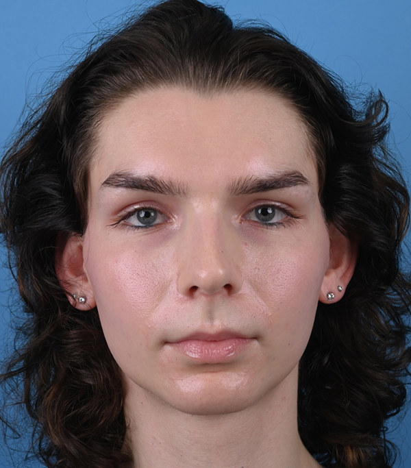 Rhinoplasty