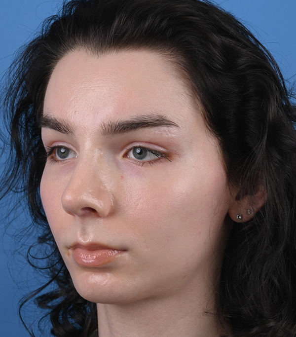 Rhinoplasty
