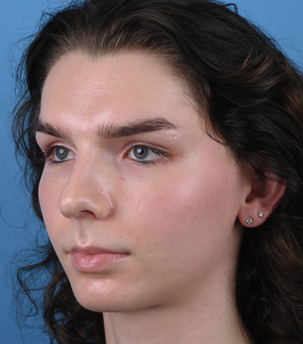 Rhinoplasty