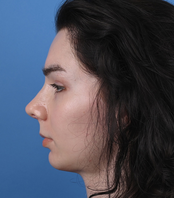 Rhinoplasty