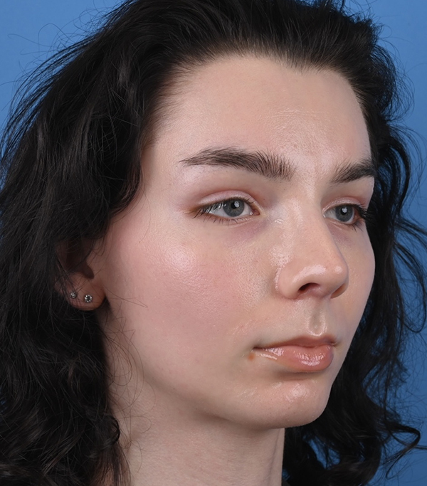 Rhinoplasty