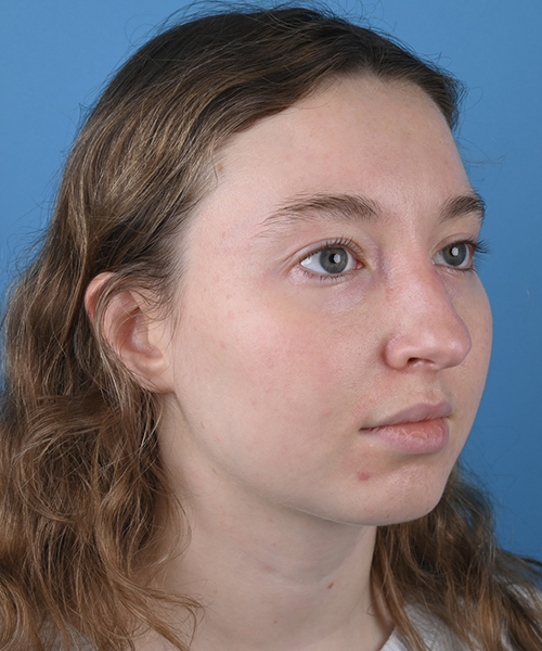 Blepharoplasty