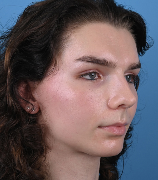 Rhinoplasty