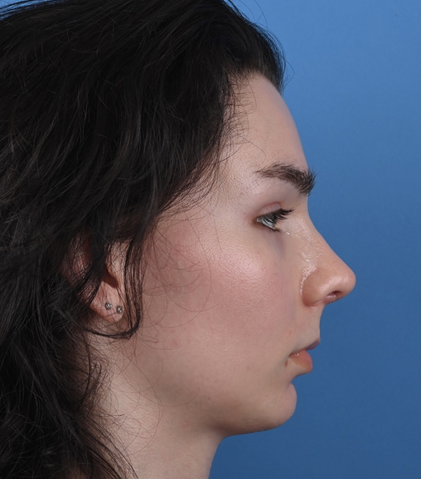 Rhinoplasty