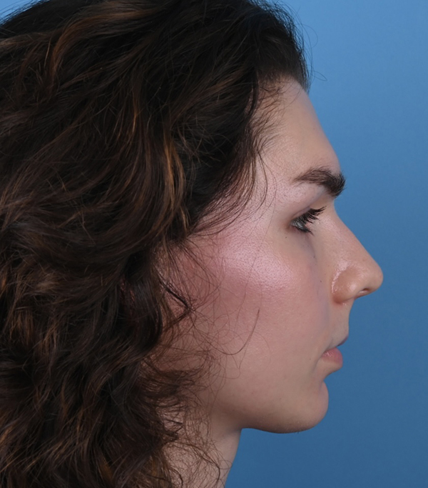 Rhinoplasty