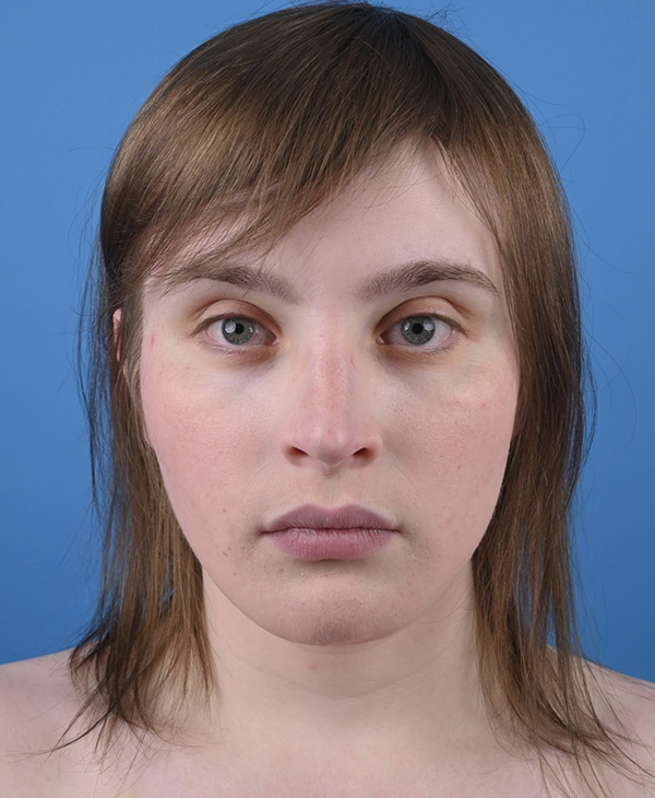 Genioplasty