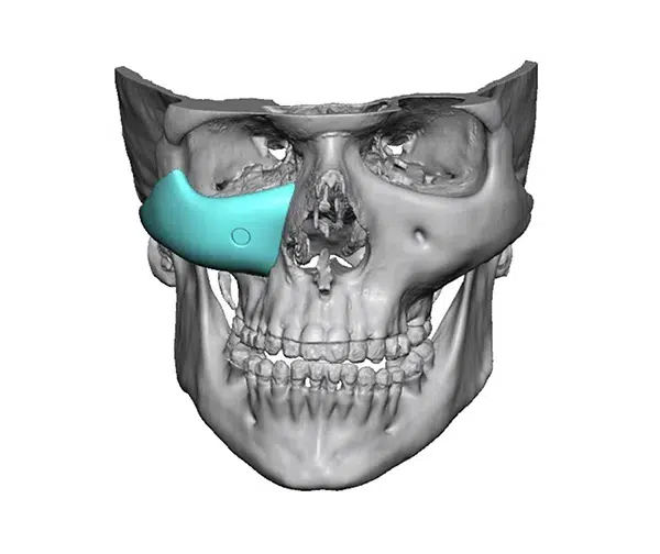 Facial Implants
