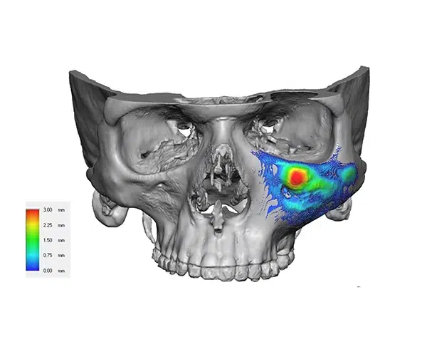 Facial Implants