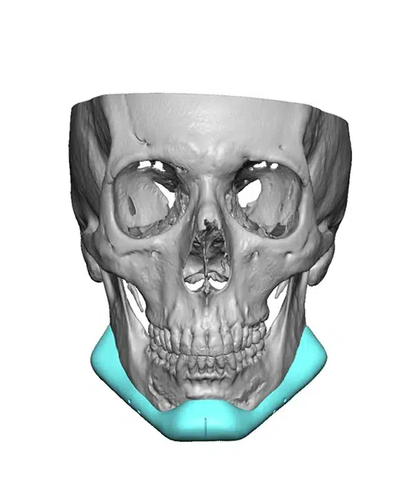 Facial Implants