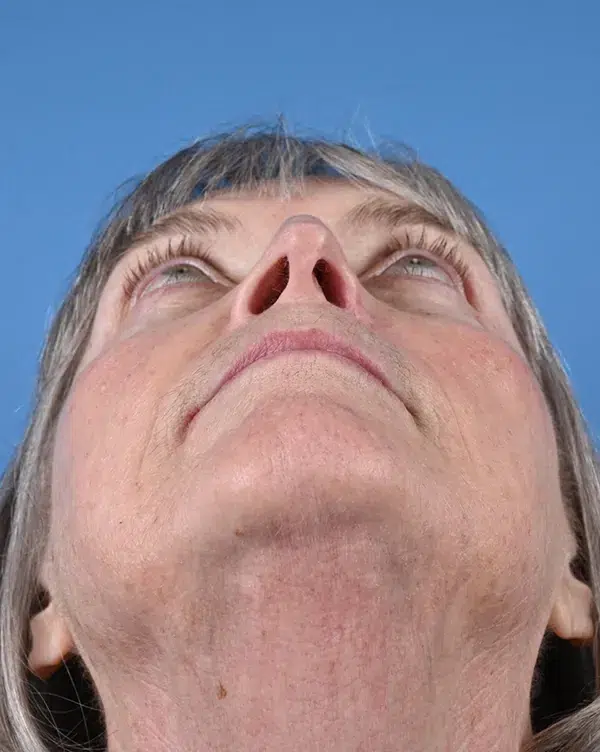 Nasal Reconstruction