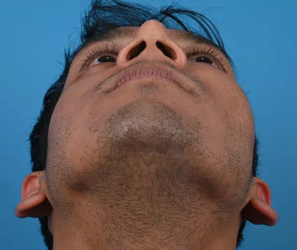 Facial Implants