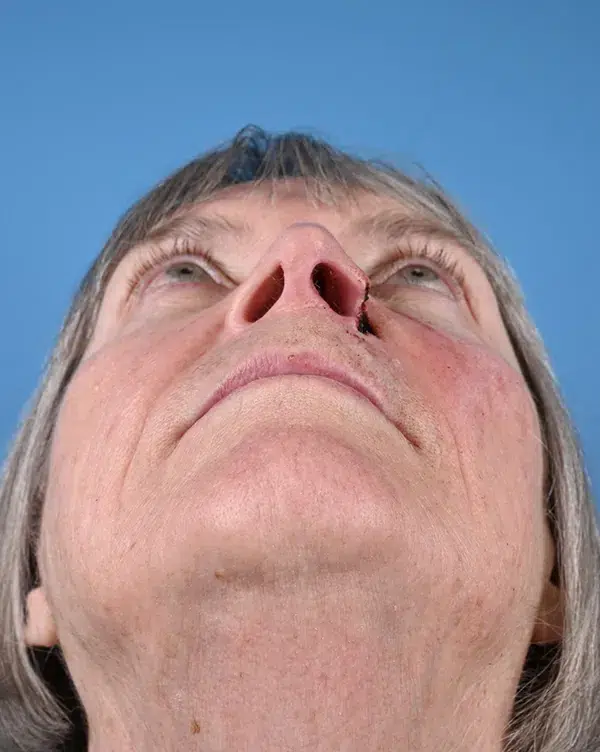 Nasal Reconstruction