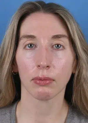 After genioplasty Front View