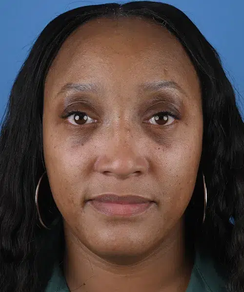 front-view-after-lower-blepharoplasty-57587