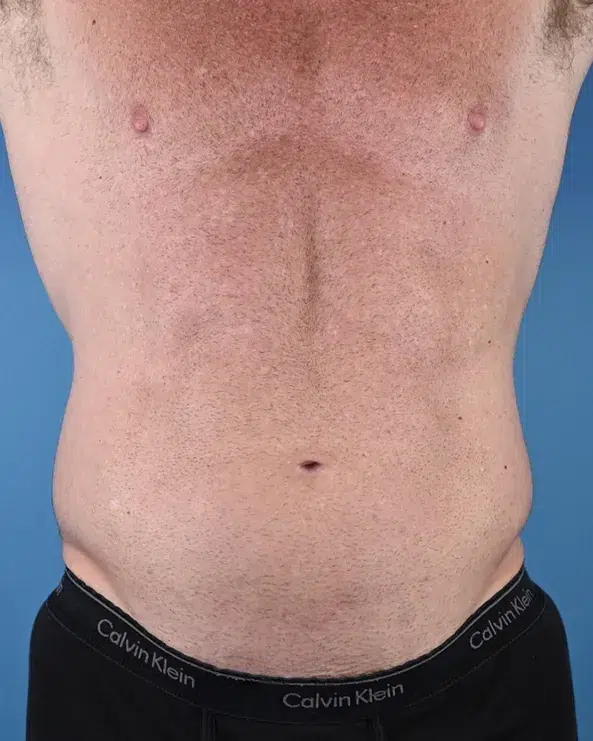 Male Abdominal Etching