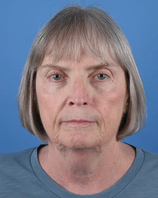 Nasal Reconstruction