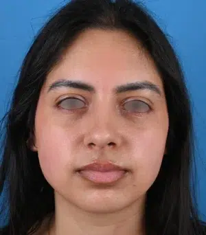 front-view-after-rhinoplasty-57690