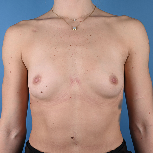 Breast Augmentation