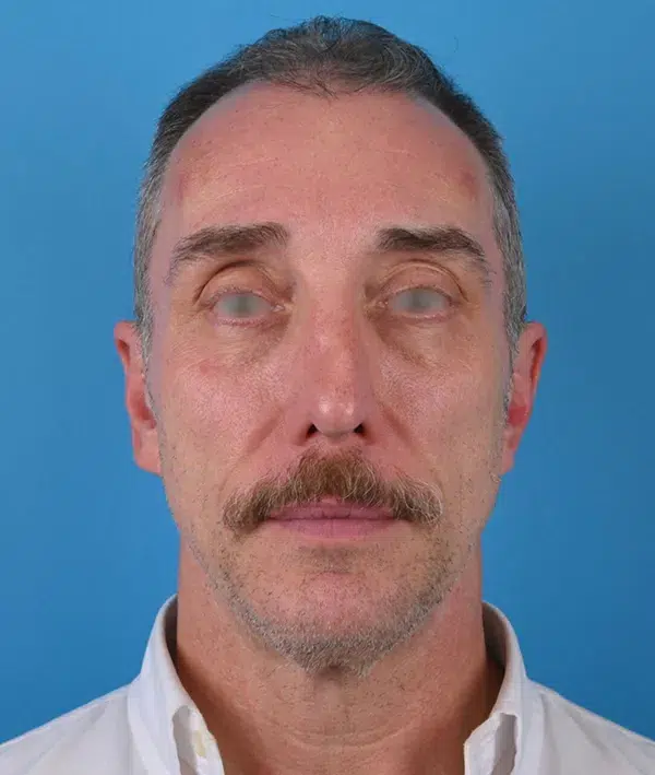 Facial Implants