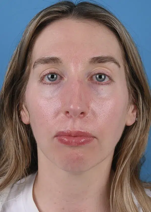 Before genioplasty Front View