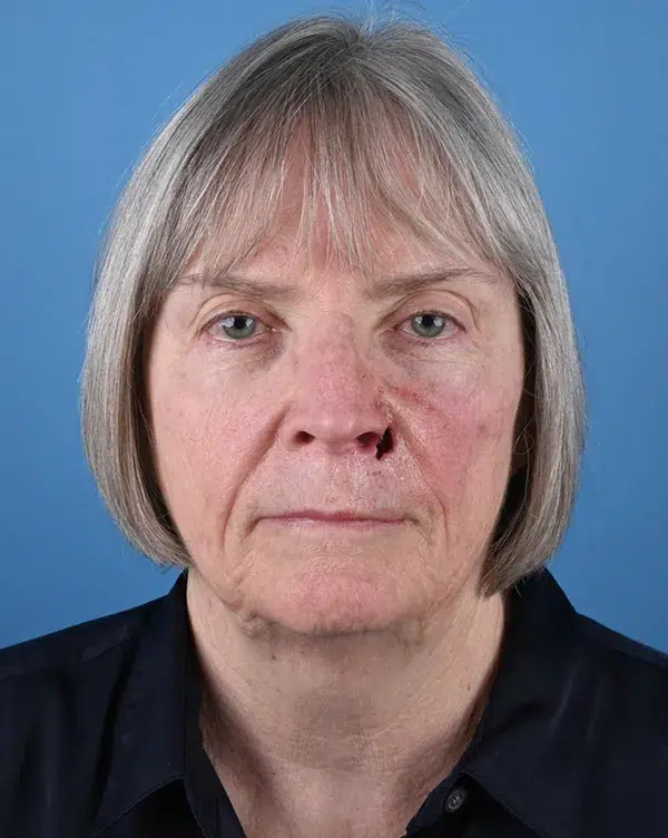 Nasal Reconstruction