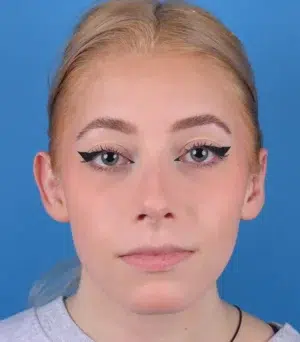 front-view-before-rhinoplasty-57514