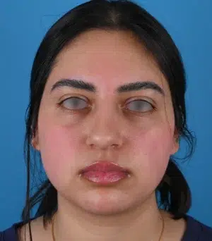 front-view-before-rhinoplasty-57690