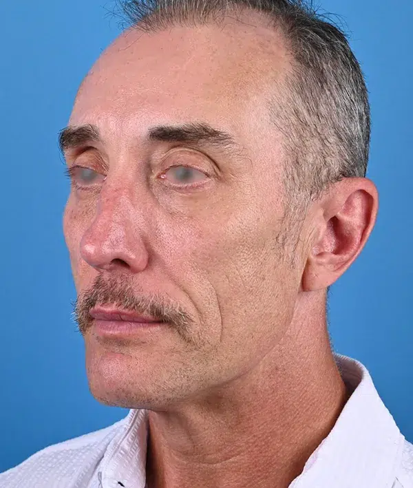 Facial Implants