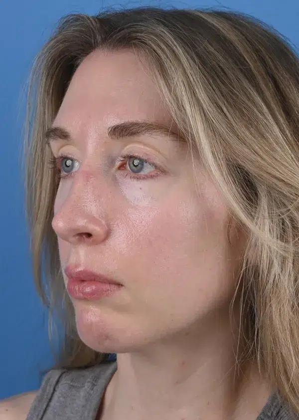 After genioplasty Left Oblique View