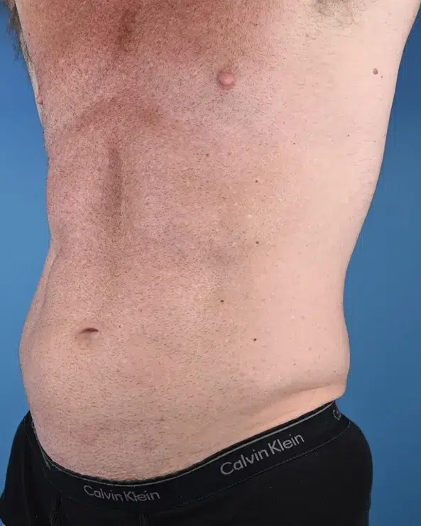 Male Abdominal Etching