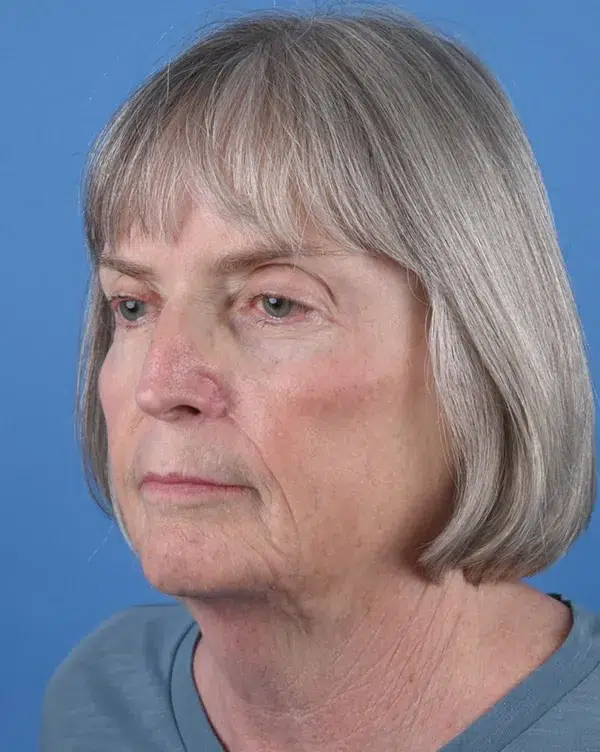 Nasal Reconstruction