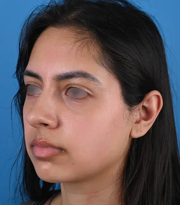 Rhinoplasty