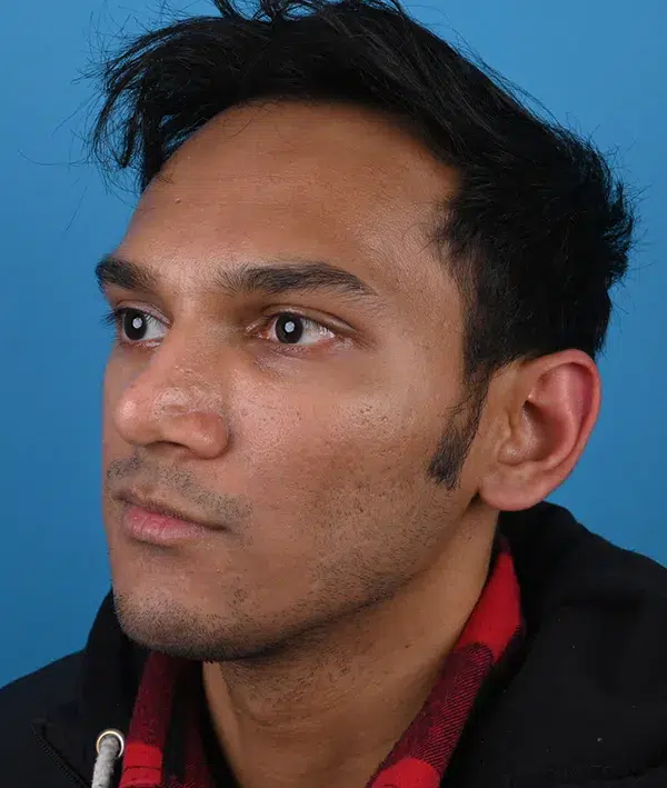 Facial Implants