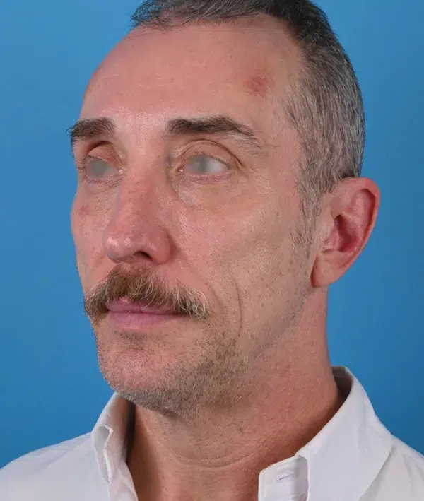 Facial Implants