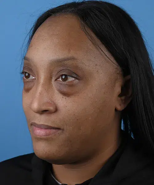 left-oblique-view-before-lower-blepharoplasty-57587