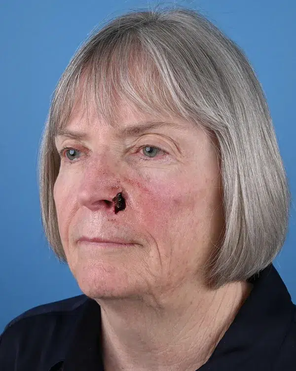 Nasal Reconstruction