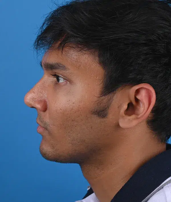 Facial Implants